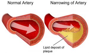 plaque cholesterol veine